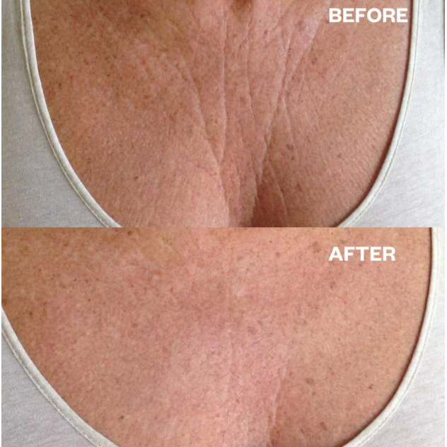 Wrinkles Schminkles Chest Wrinkle Patch