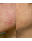 Ogee Clearganics Targeted Blemish Treatment