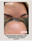 Seald™ Forehead Tape – Wrinkle Smoothing Patches