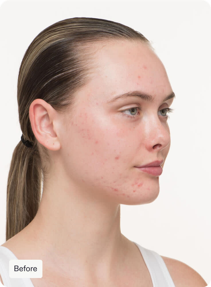 Nutrafol Skin Clear Skin Pack (3 month supply)