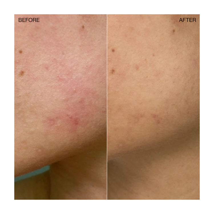 Ogee Clearganics Targeted Blemish Treatment